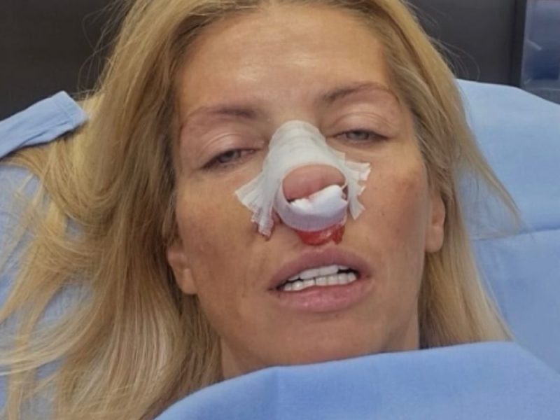 ODBORNICA KRENI-PROMENI OPERISANA NAKON NAPADA ŠAPIĆA: Tatjana Mićić zadobila prelome kostiju nosa i vilice!